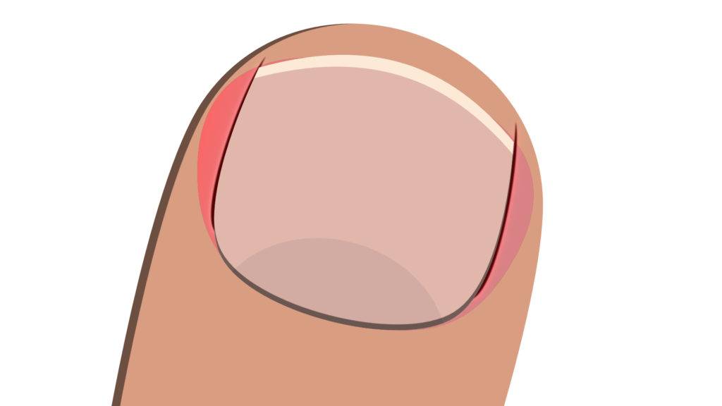 13 Common nail diseases and disorders – The Nail Tech Diaries