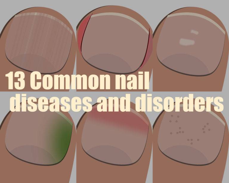 13 Common Nail Diseases And Disorders The Nail Tech Diaries