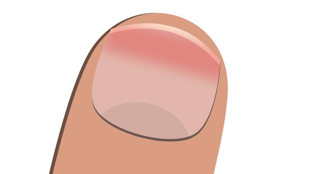 13 Common Nail Diseases And Disorders The Nail Tech Diaries