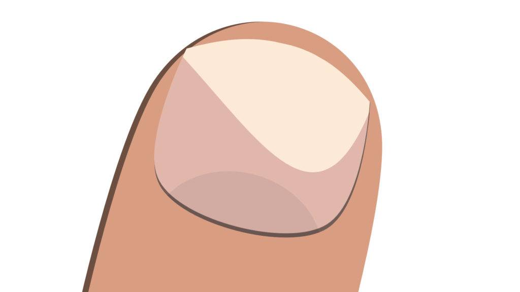 illustration of a lifted nail bed